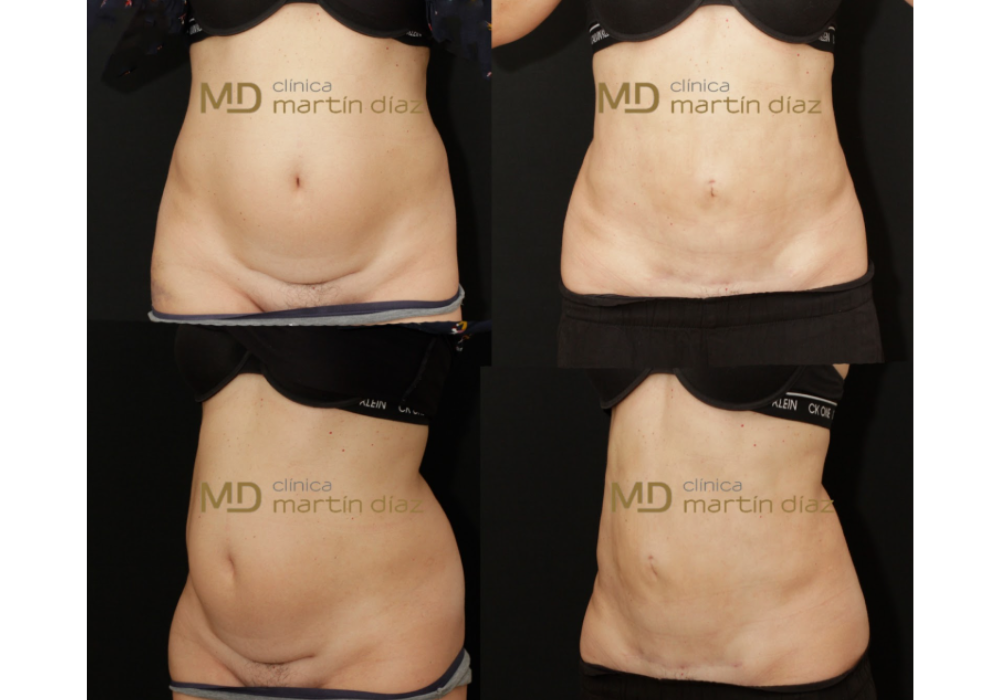 miniabdominoplastia